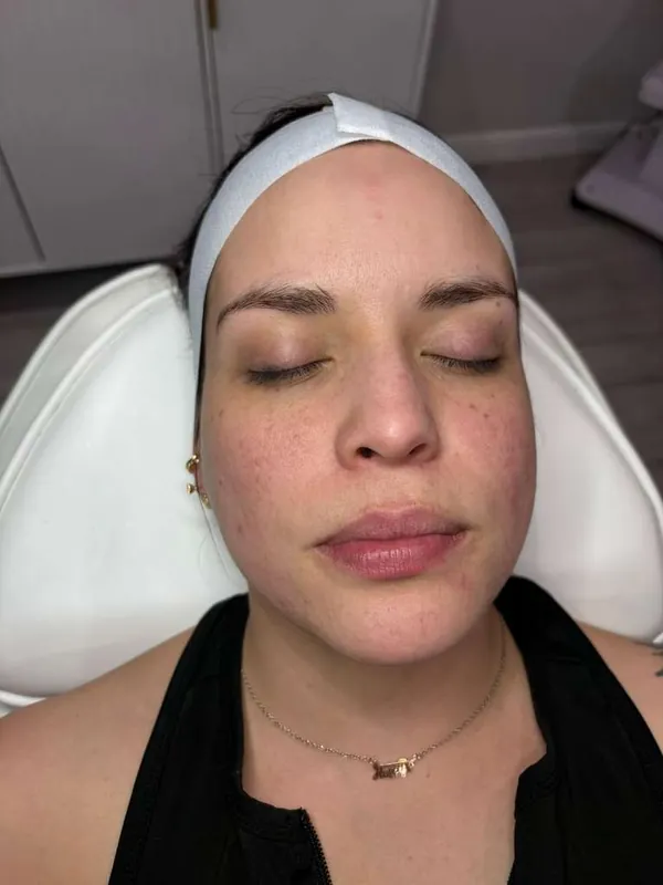 Before - Depigmentation Treatment