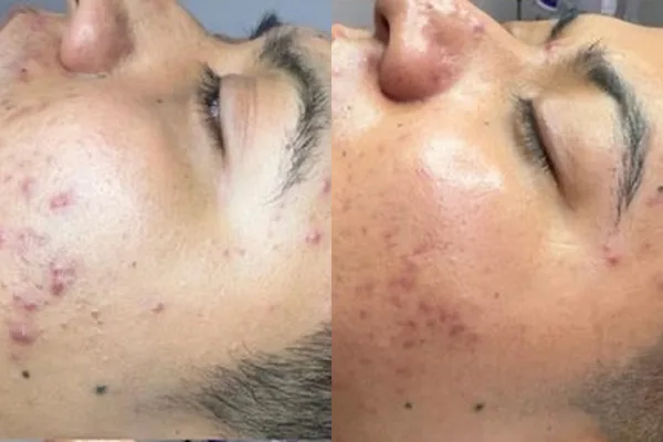 Acne treatment before and after, LP Beauty client