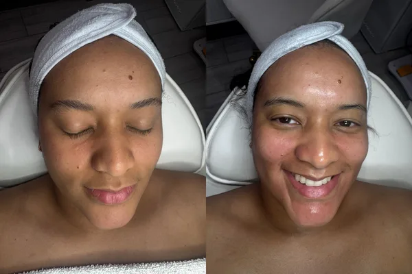 Facial treatment before and after, LP Beauty client