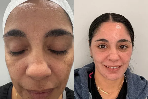 Depigmentation treatment before and after, LP Beauty client