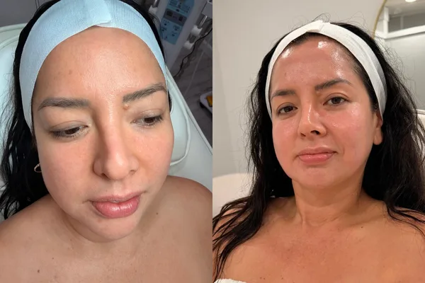Exosome and PDRN facial before and after, LP Beauty client