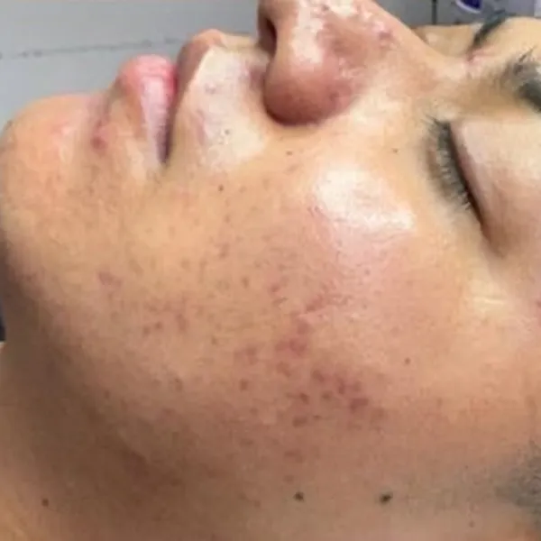 Before and after at LP Beauty & Wellness Spa