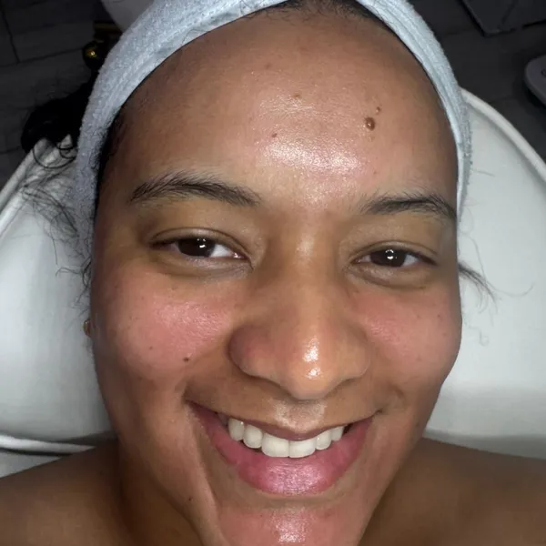 Before and after at LP Beauty & Wellness Spa