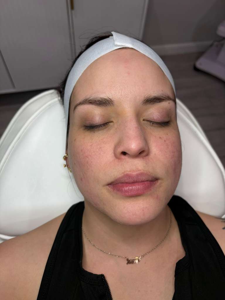 Before - Depigmentation Treatment
