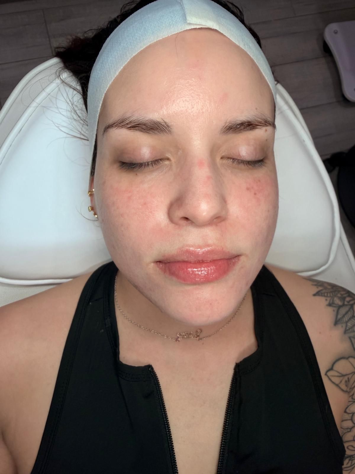 After - Depigmentation Treatment
